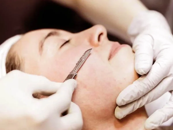 Dermaplaning - resultado