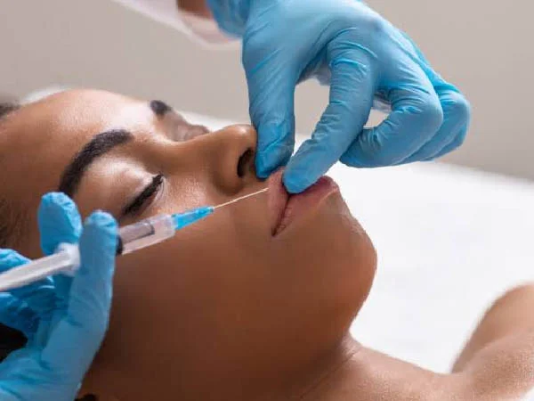 Preenchimento Labial - resultado