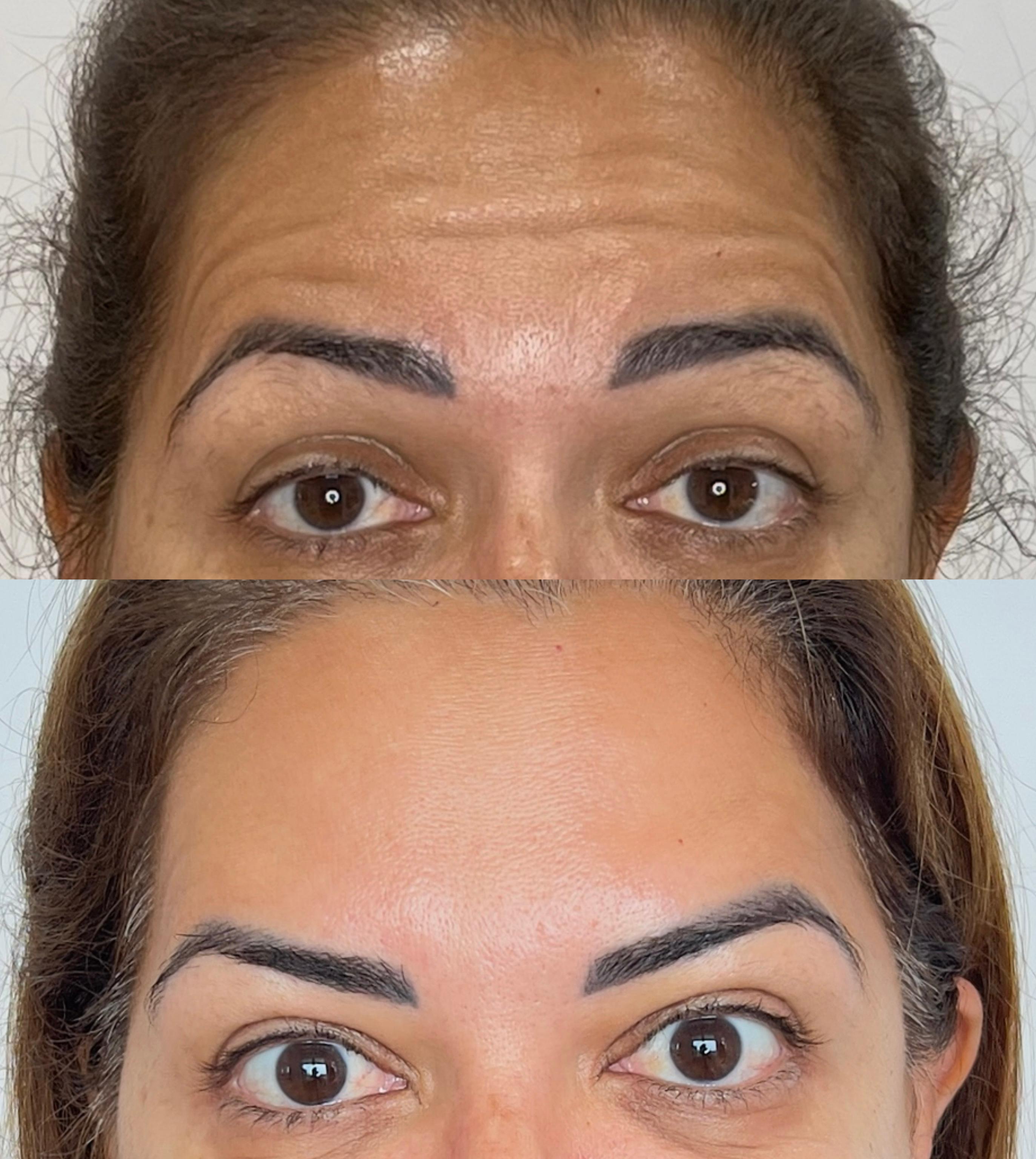 Botox - Valéria Cajaiba Clínica